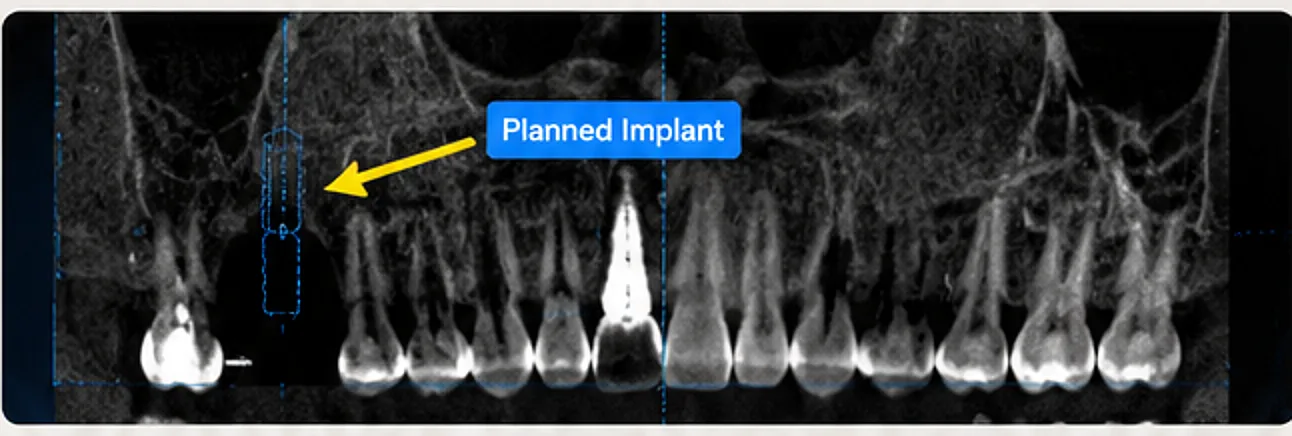 CBCT - coupe panoramique