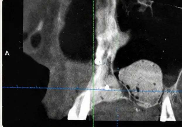 CBCT - coupe sagittale