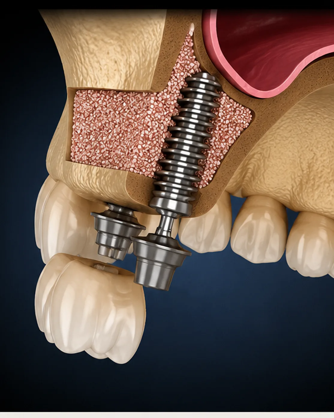 Coupe 3D - implant posé dans l'os maxillaire (greffe sinusienne)