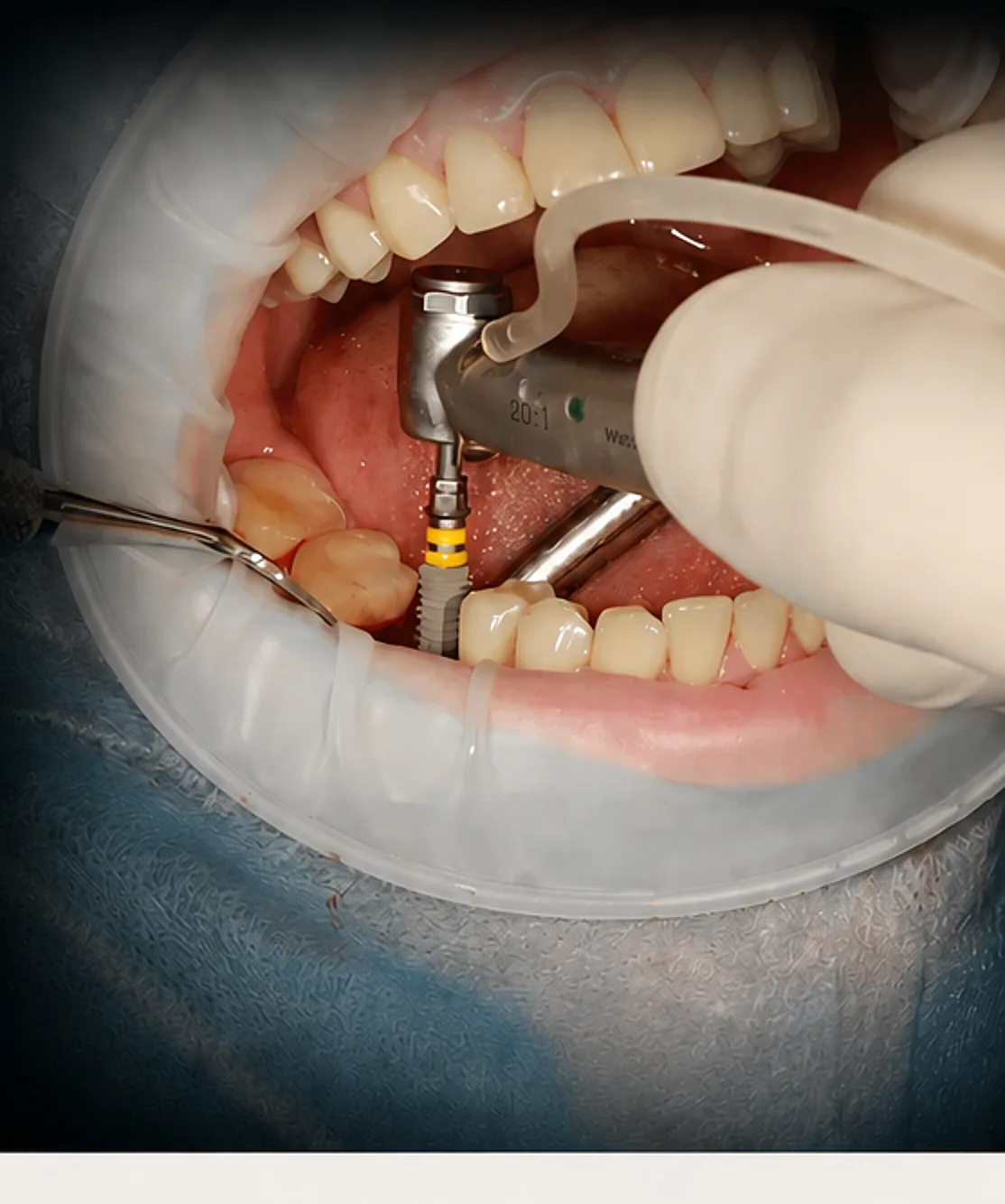 Photo intra-orale - pose d'implant (foret contre-angle)