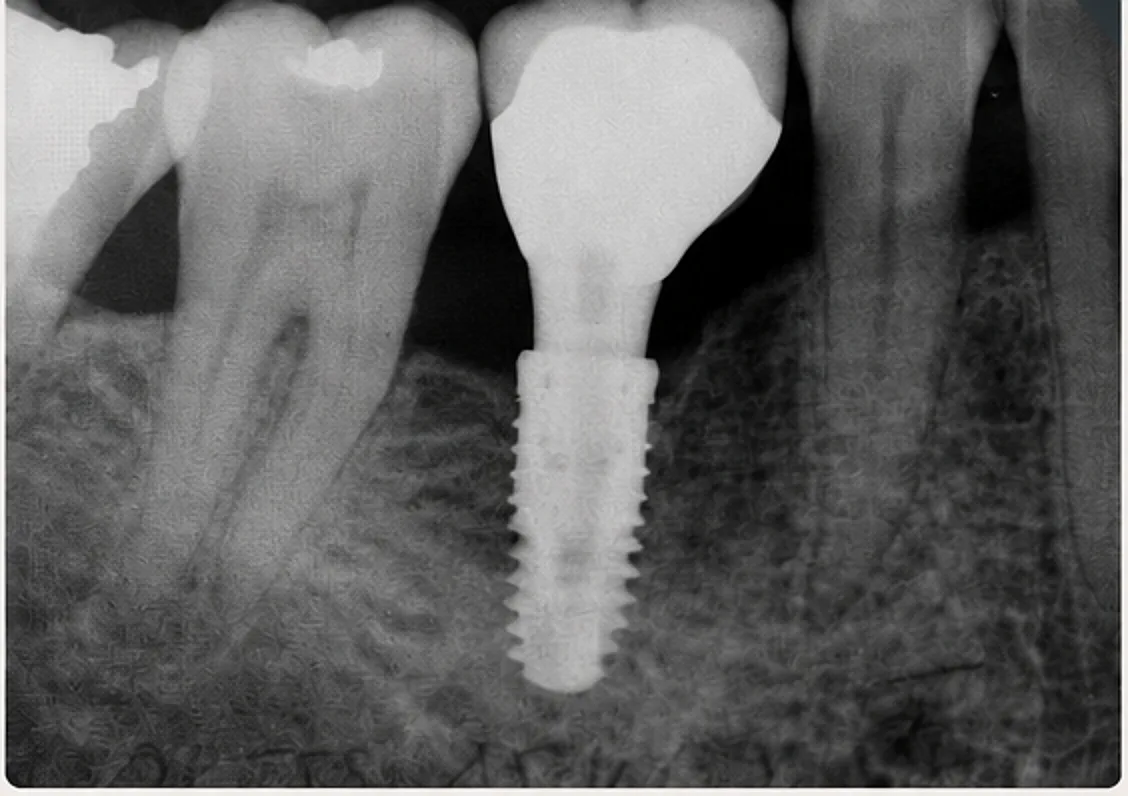 Radiographie - implant unitaire posé