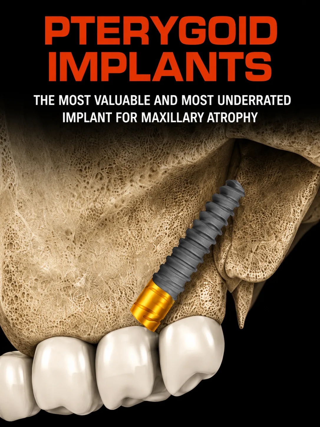 Implants ptérygoïdiens - atrophie maxillaire