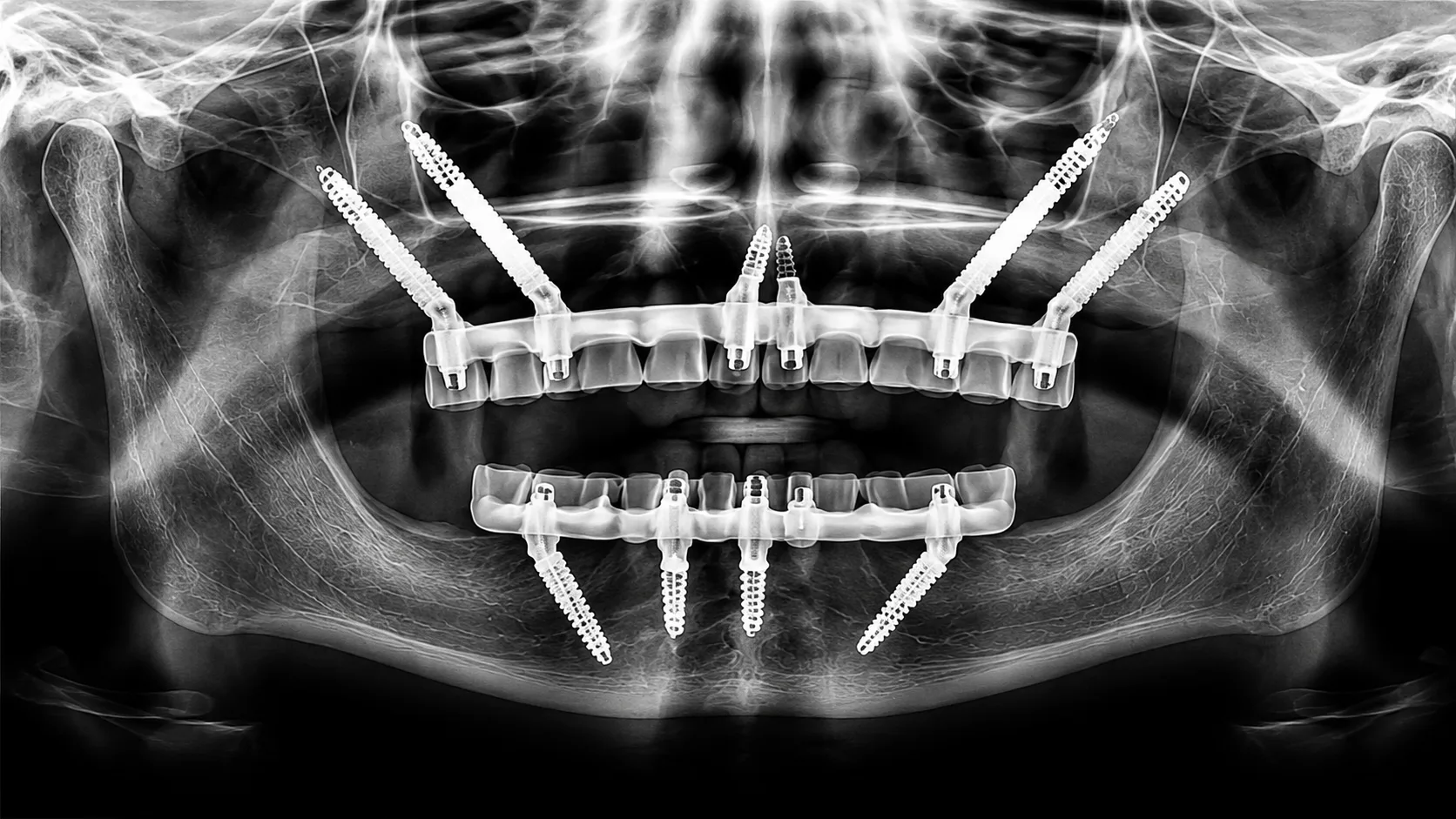 Radio panoramique - réhabilitation complète sur implants